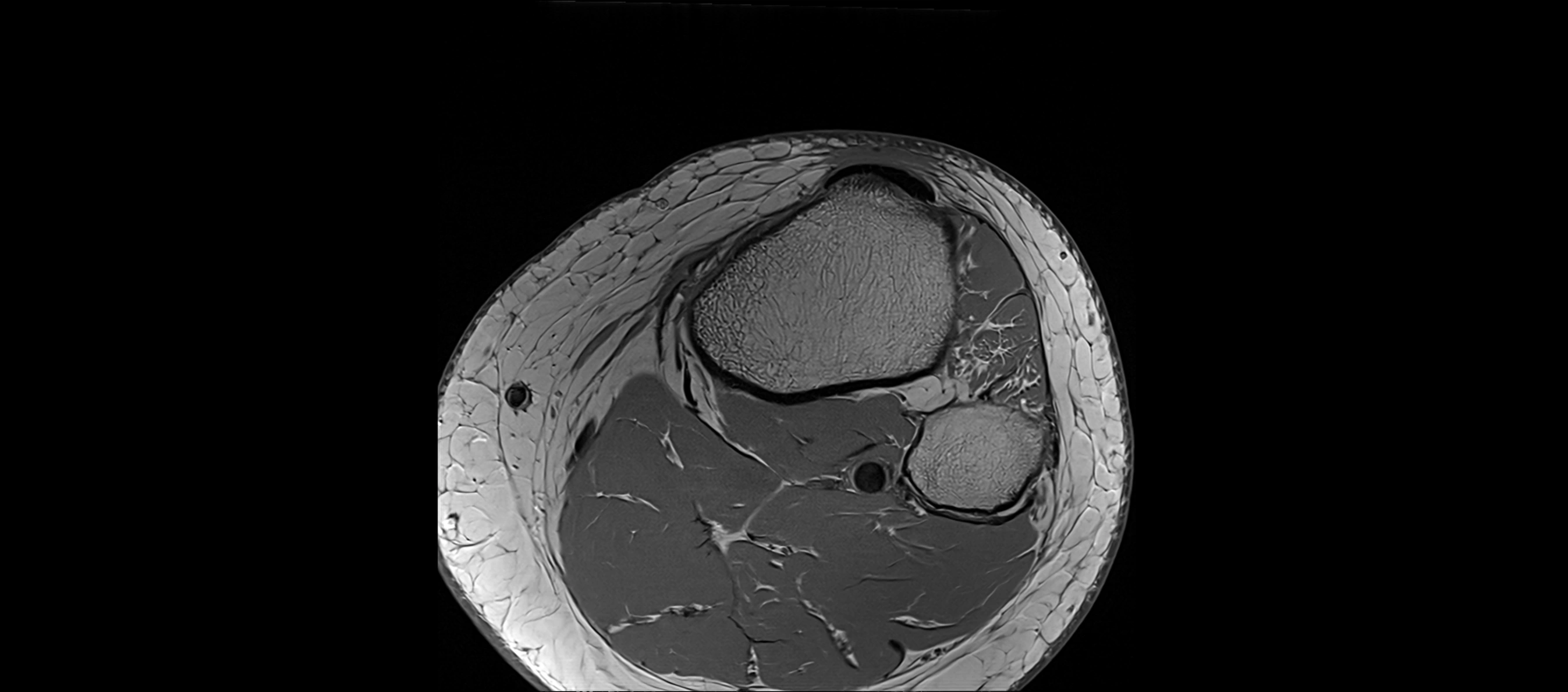 MRI Knee axial  ligaments cross sectional anatomy 3T  radiology  image-img-03001-00045.webp